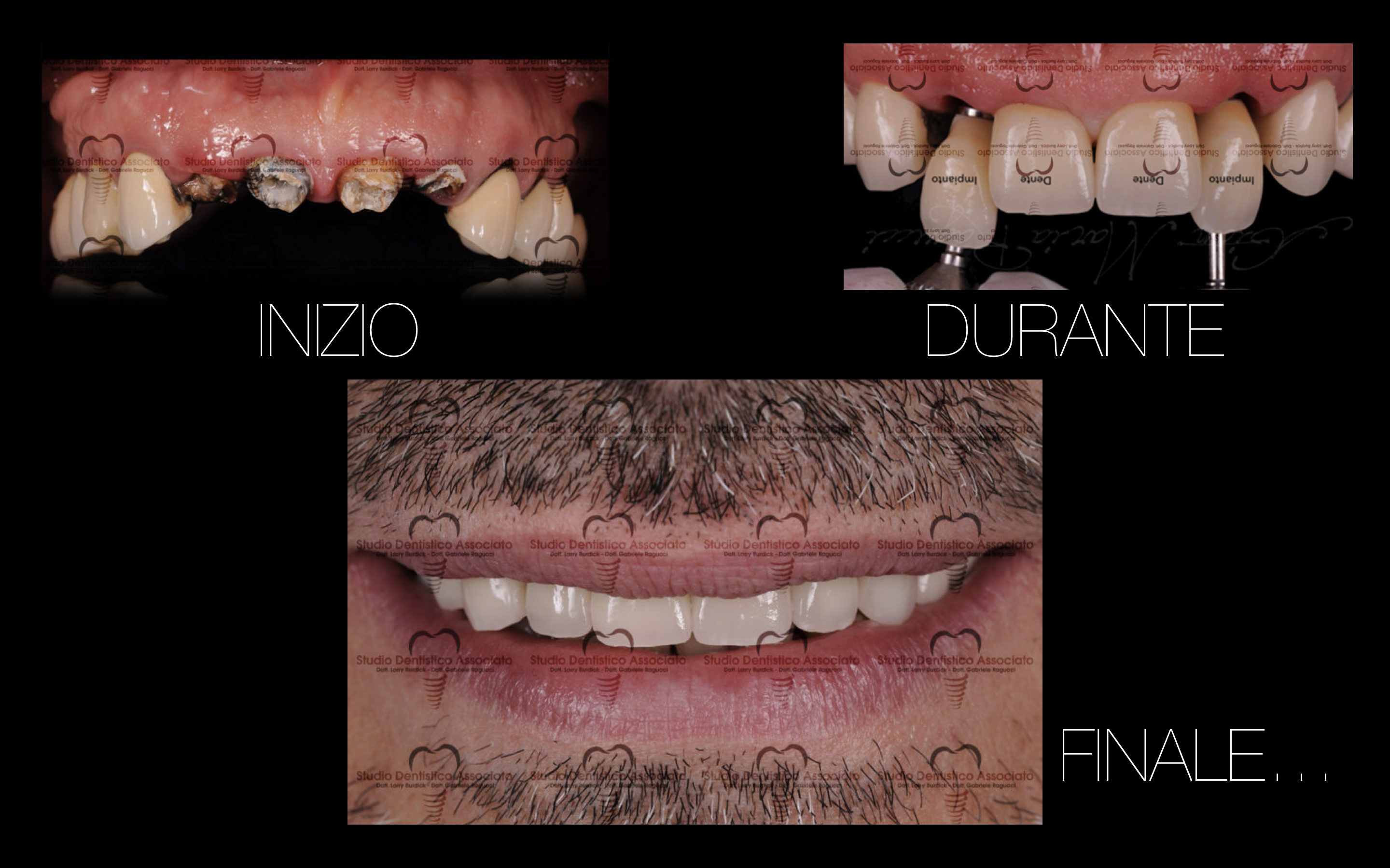 impianto dentale